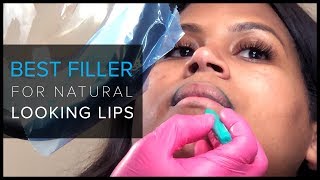 NaturalLooking Lip Injections in San Francisco [upl. by Helaina]