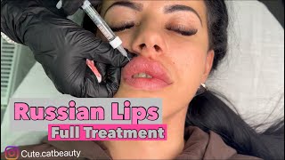 Russian Lip Technique  Lip Filler REVOLAX Deep [upl. by Ahsoek]