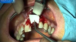 actis dentaire formation  avulsion implantation immédiate ROG immediate implant placement GBR [upl. by Kirsti]