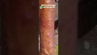 Permanent Cure in tinea manuum fungal hand  917598 456 999 [upl. by Eslek712]