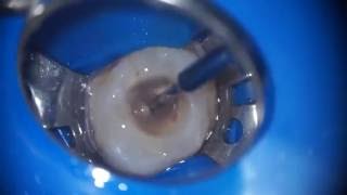 Pulpstone removal using ultrasonics [upl. by Sylvester813]