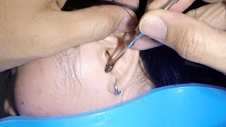 Removing Huge Earwax Stuck in Womans Ear [upl. by Yseulta690]