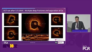 Cracking the calcium code  Novelty and utility of Hertz Contact intravascular lithotripsy  EuroPCR [upl. by Willy]