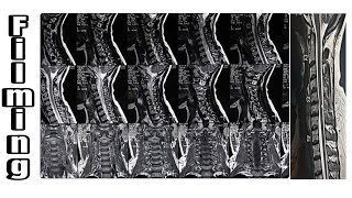 MRI CERVICAL SPINAL FILMING [upl. by Werd276]