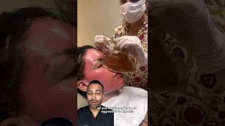 The most EXTREME Chemical Peel 😵 Dr Somji Reacts [upl. by Nemraciram]