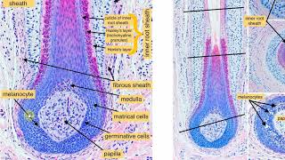 Infundibular keratinizing acanthoma [upl. by Netsyrc]