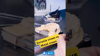 Zirconia crown vs Metal crown oralhealth dentist dentalclinic doctor viralvideo shirtscrown [upl. by Attenyt]