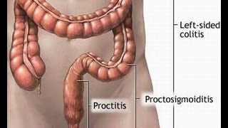 Treatment of Proctitis [upl. by Ainegul]