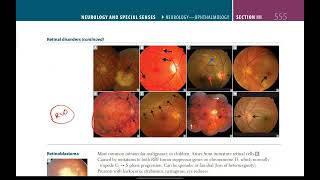 Retinal disorders  Neurology  33  First Aid USMLE in UrduHindi [upl. by Joceline297]