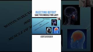 Injecting Botox Save THIS Muscle for Last [upl. by Agnesse581]