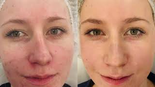 Hollywood Peel czyli laserowy peeling węglowy wykonany laserem pikosekundowym ⚡️ Pico Plus ⚡️ [upl. by Brotherson807]