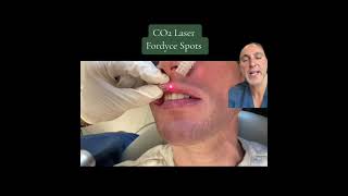 Lip Fordyce Spots Removal with CO2 Laser [upl. by Keelia]