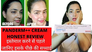 Panderm cream review  Panderm plus lagane se kya hota hai  penderm [upl. by Teplitz]