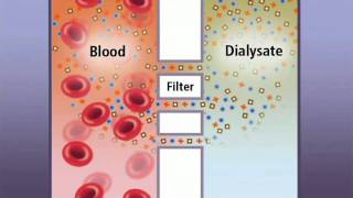 Hemodialysis and how it works  IKAN ch6  old vrs [upl. by Tonkin299]