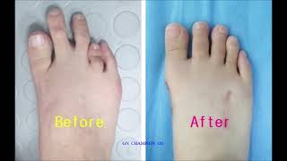 brachydactyly brachydactylysurgery 短指症手術 短指症 단지증 단지증수술 단지증수술후기 عضدي الأصابع брахидактилия [upl. by Byrle63]