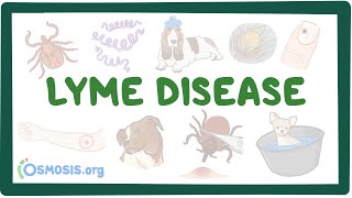 Lyme disease  causes symptoms diagnosis treatment pathology [upl. by Cown]