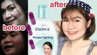 Inexpensive Acne Solution —ESKINOL and Dalacin C  PHILIPPINES  EY BELZY [upl. by Gellman]