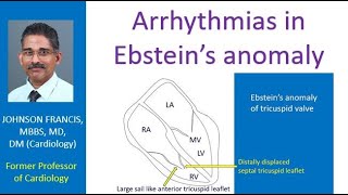 Arrhythmias in Ebstein’s anomaly [upl. by Lehcor]