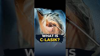 Do You Know What Is CLasik I CLasik Live Surgery [upl. by Malca]