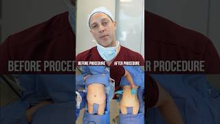 BEFORE amp AFTER  360 Lipo amp BBL fyp liposuction lipo360 bbl bbljourney plasticsurgery fypシ [upl. by Lemert43]