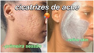 Cicatrizes de Acne  tratamento para remover cicatrizes refine skin [upl. by Aciret]