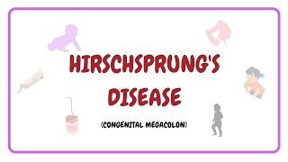 Hirschsprungs Disease  Congenital Megacolon  Symptoms  Pathophysiology  Nursing Management [upl. by Aneer]