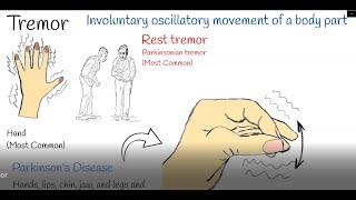 Tremor  Shaking hands hand tremors Causes and treatment Parkinson or Physiological Tremor [upl. by Annoit]