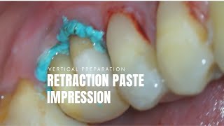 Retraction Paste amp Vertical Preparation amp Silicone Impression [upl. by Jeffries]