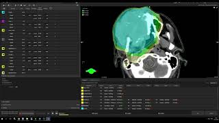 HampN planning on Halcyon VMAT vs TrueBeam IMRT [upl. by Porush]