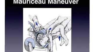 Mauriceau breach delivery manuver gynecology and obstetric OSCE [upl. by Emaj]