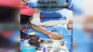 AVF Cannulation techniques  Dialysis patient cannulation dcdc ttt [upl. by Aldrich]