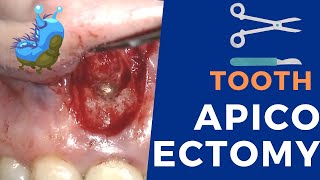 Apicoectomy surgery  Live procedure step by step [upl. by Onileba]