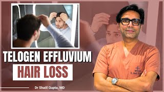 3 Common Causes of Telogen Effluvium Hair Loss You Need to Know  Dr Shaiil  Satya Hair Clinic [upl. by Daisie673]