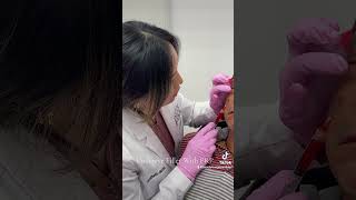 Undereye PRP Treatment [upl. by Anastos844]