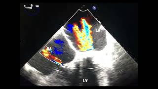 Para valvular versus trans valvular leak to drahmadmirdamadisicUcsbhOAVuyi4L6y [upl. by Eissed643]