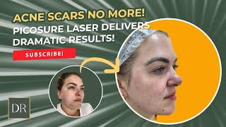 Acne Scars No More Watch PicoSure Laser Deliver Dramatic Results [upl. by Alikam703]