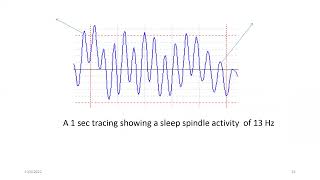 Waveforms in Sleep study [upl. by Doughman402]