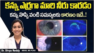 నల్ల గుడ్డుపై గాయం  Symptoms and Treatment of Recurrent Corneal Erosion  Best Vision Eye Hospital [upl. by Andri]