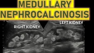 BILATERAL MEDULLARY NEPHROCALCINOSIS ON USG  And its causes [upl. by Nedac451]