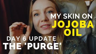 Jojoba Oil On AcneProne Skin Day 6 Purge [upl. by Dustan294]