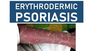 Erythrodermic Psoriasis [upl. by Nyliret]