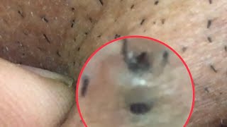 Twin cystic blackheads [upl. by Leahicm]