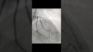 Complex LAD CTO Angioplasty [upl. by Yarahs]