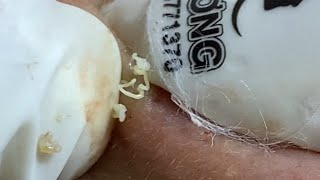 Acne Treatment Huong Da Nang  2024 Acne Huong 713 [upl. by Zipah]