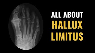 Hallux Limitus  Dr Donald Pelto  Worcester Podiatrist [upl. by Dranyer]