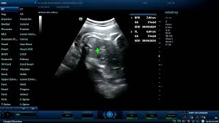 Three cases of intrauterine fetal demise and one missed mischarge case  Diagnostic ultrasound cases [upl. by Atnahs]