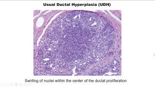 Breast Pathology Case 2 [upl. by Brucie542]