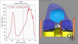 Mechanical and Kinematic Alignment in Total Knee Arthroplasty A Computational Kinematic Study [upl. by Vasily]