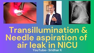 Transillumination and needle aspiration in treatment of air leaks in neonates pneumothorax [upl. by Biagi13]