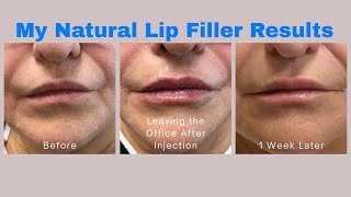 Elenas Natural Lip Filler Results Over 60 KysseLipFiller [upl. by Hanyaz]